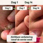 DermaShield – Vernietigt huidinfecties direct bij de bron. 1+1 Gratis!